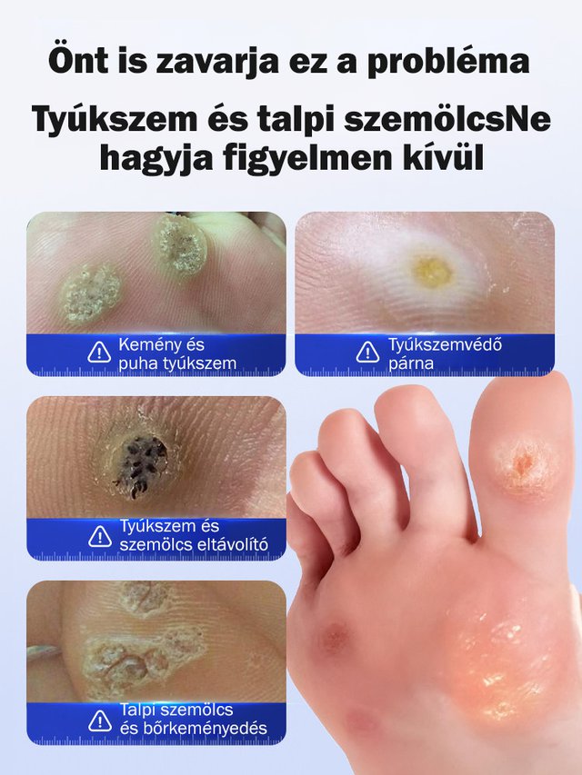Tyúkszem eltávolító folyadék